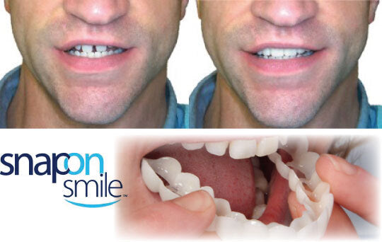Dientes postizos Carillas